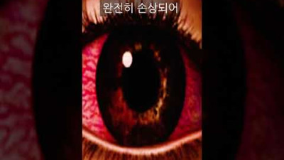 뾰족한 것에 눈이 찔리면 반드시 이렇게 하세요 (모르면 실명됩니다)